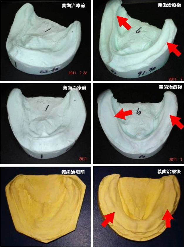 義歯治療例