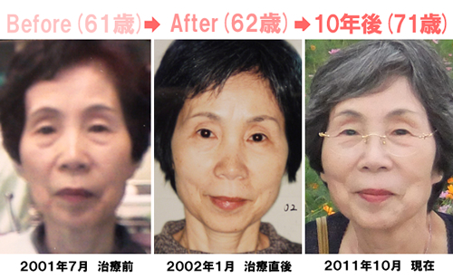 大西歯科で治療を受ける前と後、１０年後の今のお写真を比較